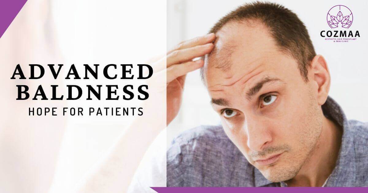 Patients with advanced baldness have hope thanks to body hair transplants