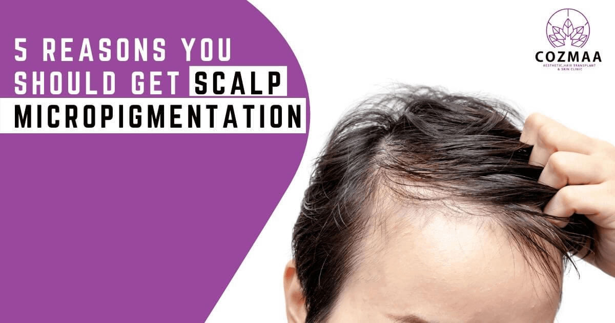 Five Reasons You Should Get Scalp Micropigmentation Treatment