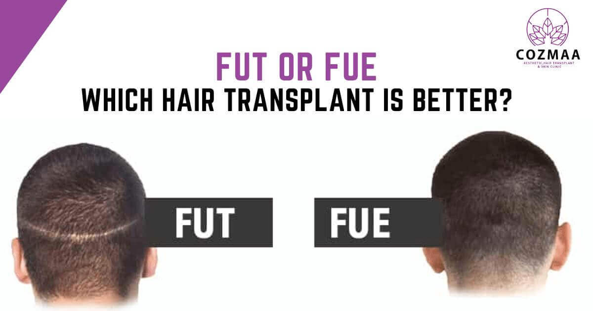 FUE vs. FUT: Which Is The Better Hair Transplant Method?