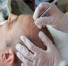 Laser Treatment