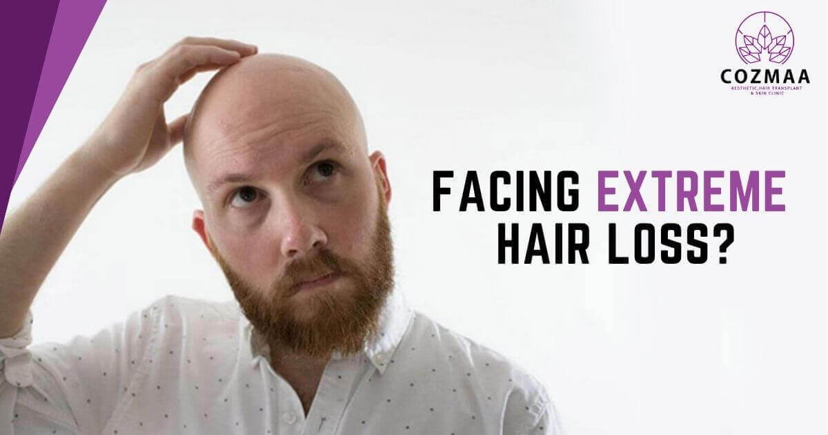 Hair Loss Suffering from hair fall Tips to regrow hair on a bald spot   TheHealthSitecom