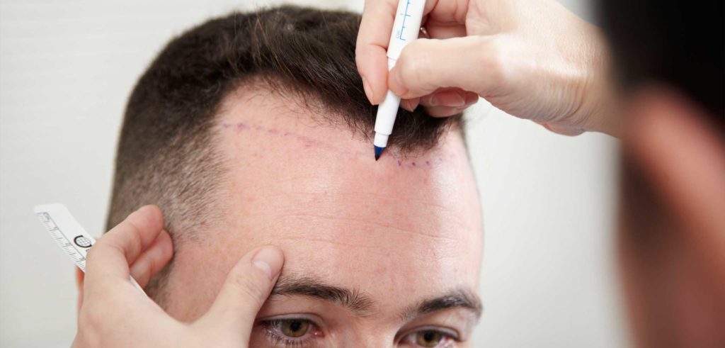 Hair Transplant for Women  Rejoice Hair Transplant